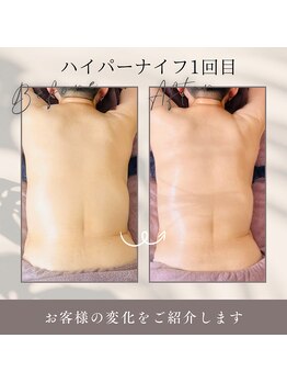 ソフィアアイズ 倉敷店(SOPHIAEYES)/ハイパーナイフ7効果