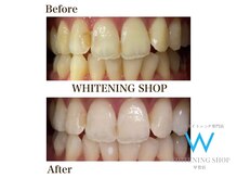 ホワイトニングショップ 甲賀店/Before&After『ホワイトニング』