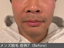 オアシスラグーン(OASIS LAGOON)/メンズ脱毛（症例7 before）