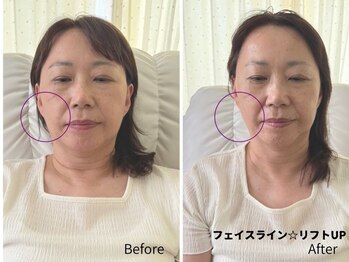 ミラ 中央林間(mira)/小顔 毛穴 ほうれい線 ハリ弾力