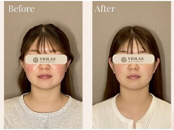 ビオラス(VIOLAS)の写真/《国家資格保持の女性施術者が担当/完全個室の女性専用美容鍼灸サロン》 肌質改善・リフトアップ・小顔◎