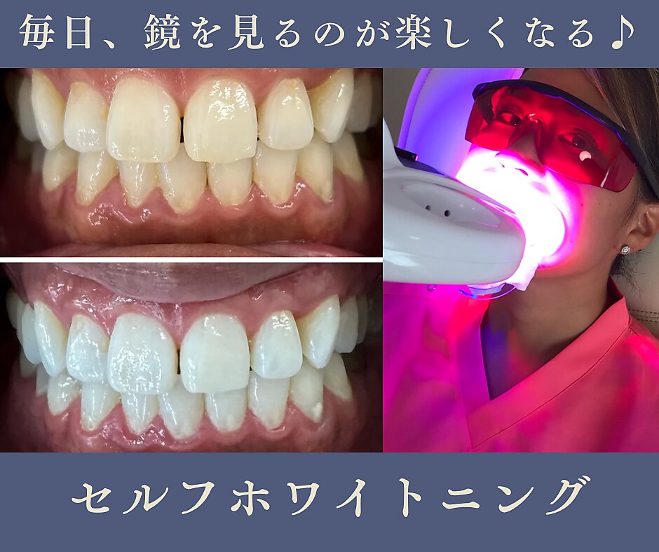 歯のセルフホワイトニング グリッター ショウナン(glitter.SHONAN)｜ホットペッパー