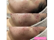 毛穴ケアで大人ニキビでお悩みの方も本来の美しい素肌へ！