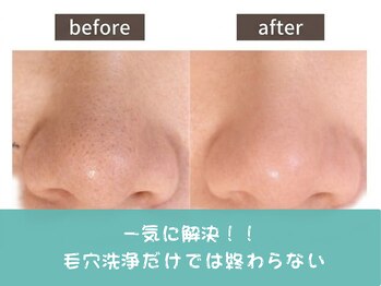 ココミエレ(COCO MIELE)/黒ずみ毛穴ビフォーアフター