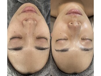 サラ 神楽坂(Sara)の写真/毛穴だけで終わらない。40代から始める肌質改善で、自信の持てる素肌へ♪