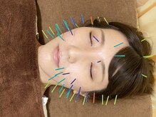 八木整骨院 八木針灸院/最高の美容鍼：美容鍼１２０分