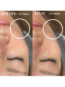 アマリリス(Amaryllis)/サーマトリックスのBefore/After