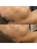 小顔効果抜群☆【たるみ/二重あごケア】脂肪分解！美容溶解フェイシャル