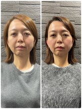 長寿鍼灸院 長寿整骨院/美容鍼50本の効果★小顔効果