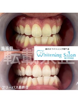 ホワイトニングサロン 福岡天神店/ホワイトニング