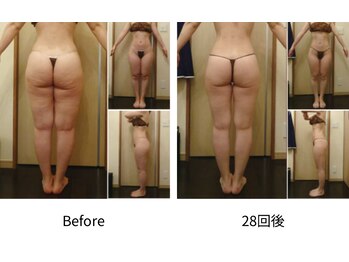 ルル 北仙台/痩身後の弛んだ肌を呼び戻す