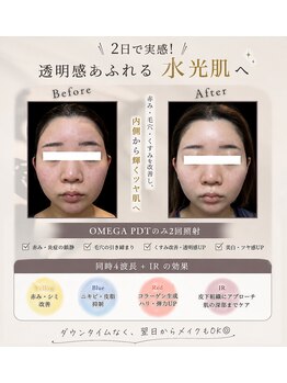 ノエル(Noel)/たった2回で透明感爆誕！？