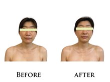 アペルコス(APERCOS)/〔肌質調整エステ〕before/after