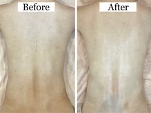 ルヴィカカリーナ(REVI Cacalena)/背中ケアコース