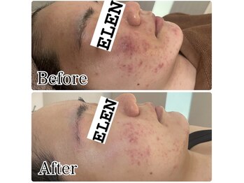 エレン(Elen)/【肌質改善】ハーブピーリング