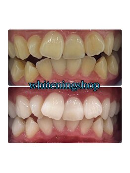 ホワイトニングショップ 所沢店/ホワイトニングショップ所沢店