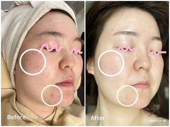 ラウレア 松山店(LAULEA)/ハーブピーリング　before/after