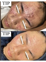 イベリス(Iberis)/ハーブピーリング/ニキビケア