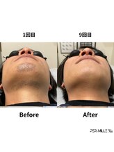 パーミル 楠葉店(per mille‰)/Before/After