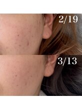 スイ(Sui)/光フェイシャル　光脱毛