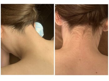 シナジー スパ(synergy spa)/全身脱毛