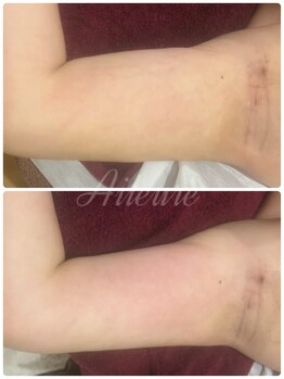 エルール トータルビューティ(Aileure total beauty)/術後ケア 二の腕