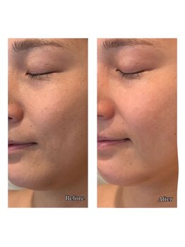 ブリス(BLiSS)/ホーム用カーボキシー炭酸パック