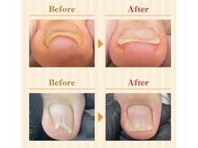 巻き爪専門の施術で巻き爪の痛みを根本から改善