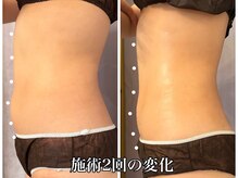 リラ(Lilas)/ぽっこりお腹