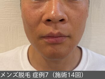 オアシスラグーン(OASIS LAGOON)/メンズ脱毛(症例7 施術14回)