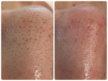 ドアディ(Doordie)/韓流毛穴洗浄スキンサクション