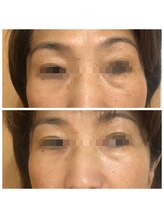 ラ ドウ 名古屋黒川店(la.dow)/たるみ/しわ改善60分コース1回目