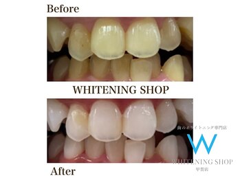 ホワイトニングショップ 甲賀店/Before&After『ホワイトニング』