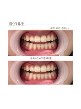 ホワイトニングサロンブライト 尼崎店(Whitening salon bright)/ご新規様のbefore/after