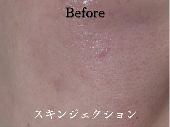 ダイヤモンド リーエンダ(Diamond leende)/スキンジェクション