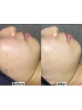 アンドミー 鹿児島中山(&me)/ ララピール【美白/赤み改善】