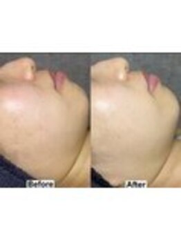 アンドミー 鹿児島中山(&me)/ ララピール【美白/赤み改善】