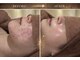 ビジュー(Bijou)の写真/剥離なし、痛みなしの陶肌トリートメントで肌質改善！ニキビがひどい方、お肌が弱い方でも施術が可能です