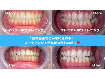アトリエの写真/【1回の施術でここまで変わる】プレミアムセルフホワイトニング☆輝く白さがマッハで実現♪大切な日の前に