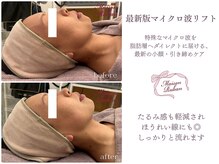 メゾンリュバン 梅田店(Maison Ruban)/最新版小顔マイクロ波リフト