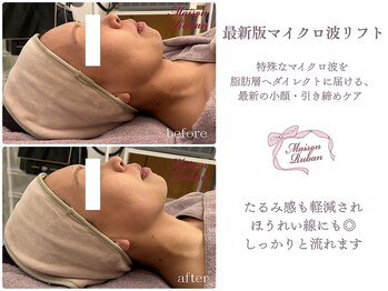 メゾンリュバン 梅田店(Maison Ruban)/最新版小顔マイクロ波リフト