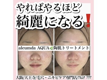 アルムダアクア 天王寺店(Aleumda AQUA)/毛穴エクストラクションプロ大阪