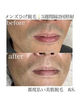 アンドエス(&S.)/青髭のお悩みに☆