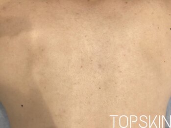 トップスキン 表参道(TOPSKIN)/メンズ/背中ハーブピーリング