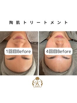 ケイサロン 朝霞店(K salon)/陶肌トリートメント