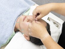 キュアハンズ 大森/美容鍼　咬筋調整