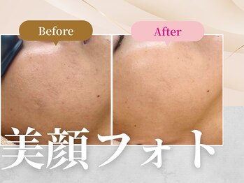 フェルナ 上新庄店(FERNA)/フェイシャル