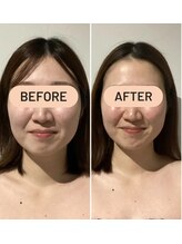 ルミナ(LUMINA)/小顔コルギ　Before→After