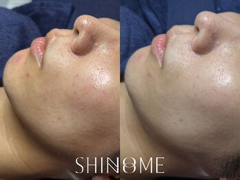 シノノメ(SHINONOME)/*日焼け後の赤み