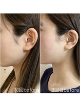 毛穴塾/話題の小顔マイクロリフト